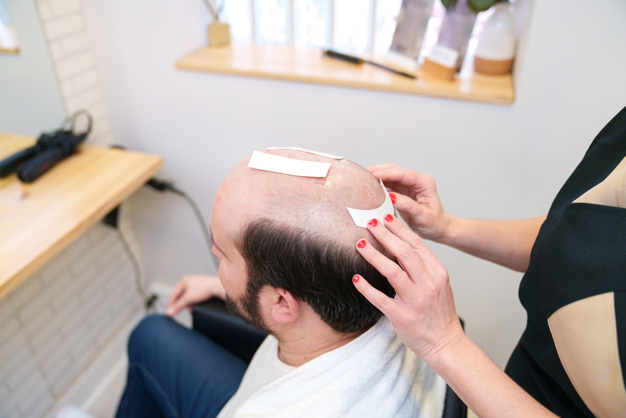 Hair Transplant